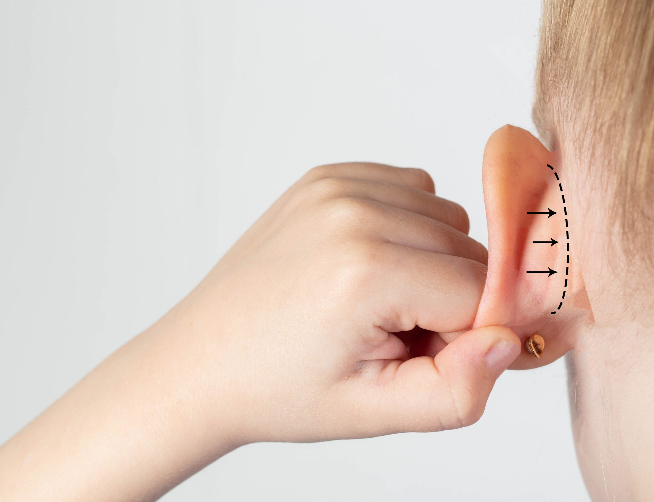 The girl holds her hand on her protruding protruding ear with marks for plastic surgery. Changes in the shape of the pinna and ear. Pediatric otoplasty. Copy space for text girl holds her hand on her protruding protruding ear