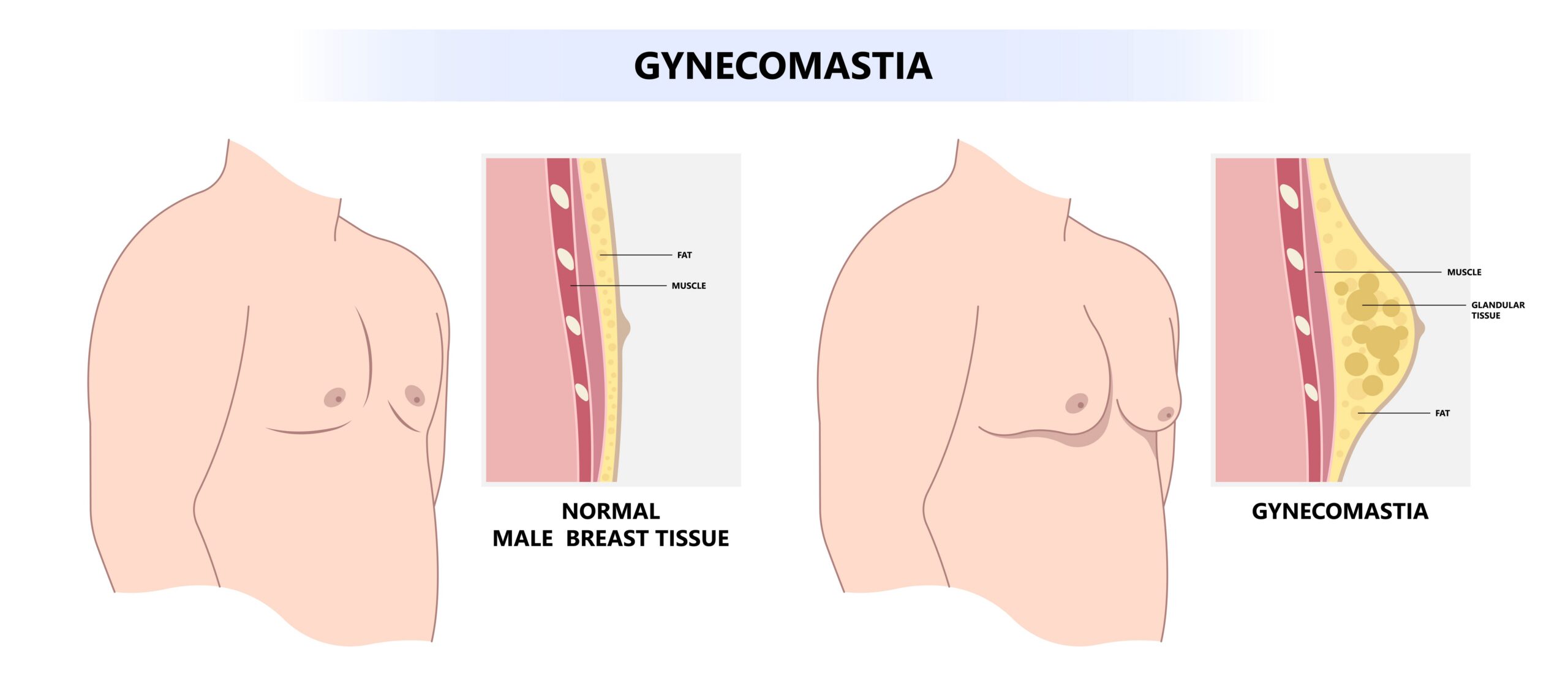 Gynecomastia Man with fat tissue on the chest comparison in medical