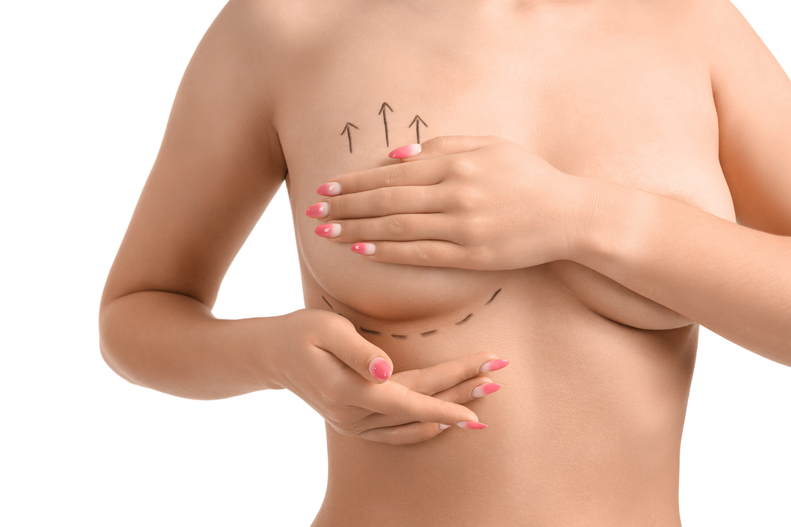 young woman with marks on her breast against white background, closeup. Plastic surgery