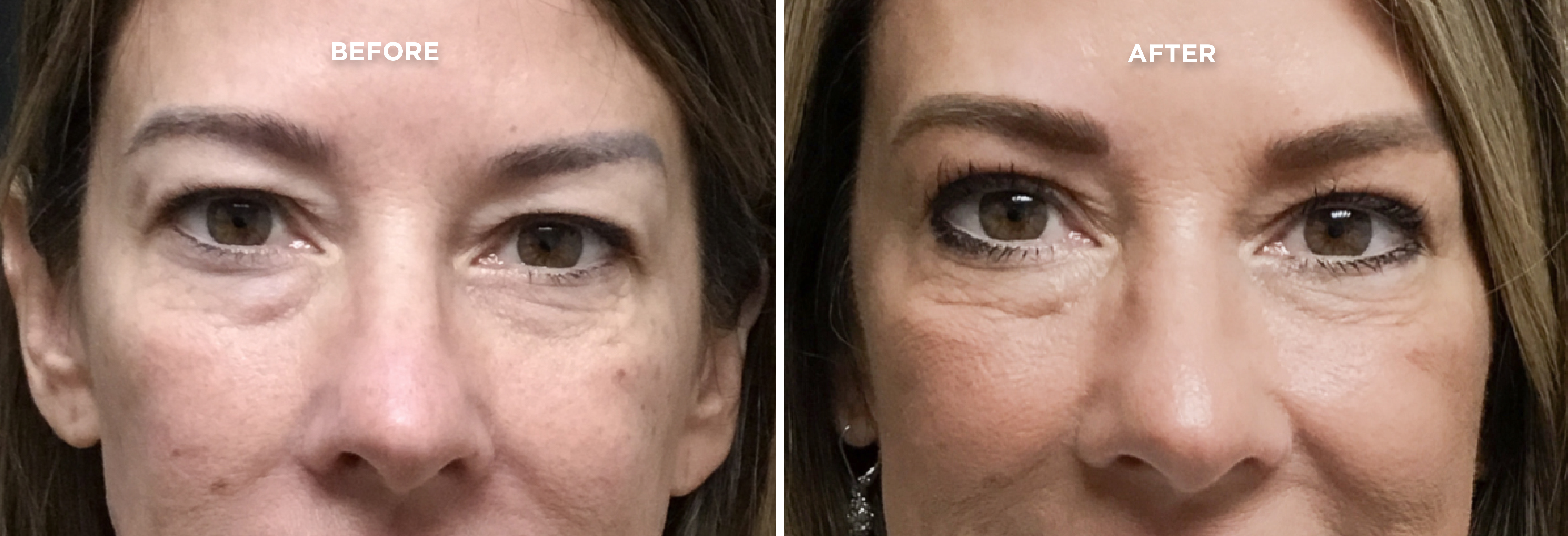 UPPER BLEPH BEFORE AND AFTER 1