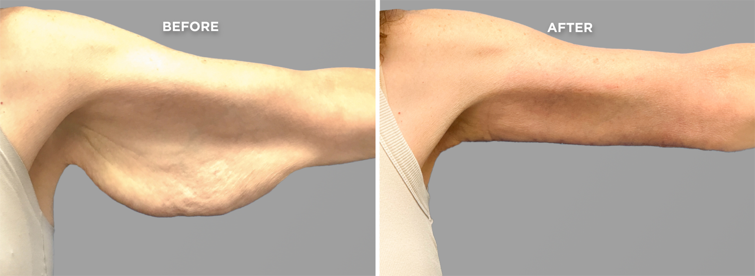 Breast Augment & Lift Before and After side 1