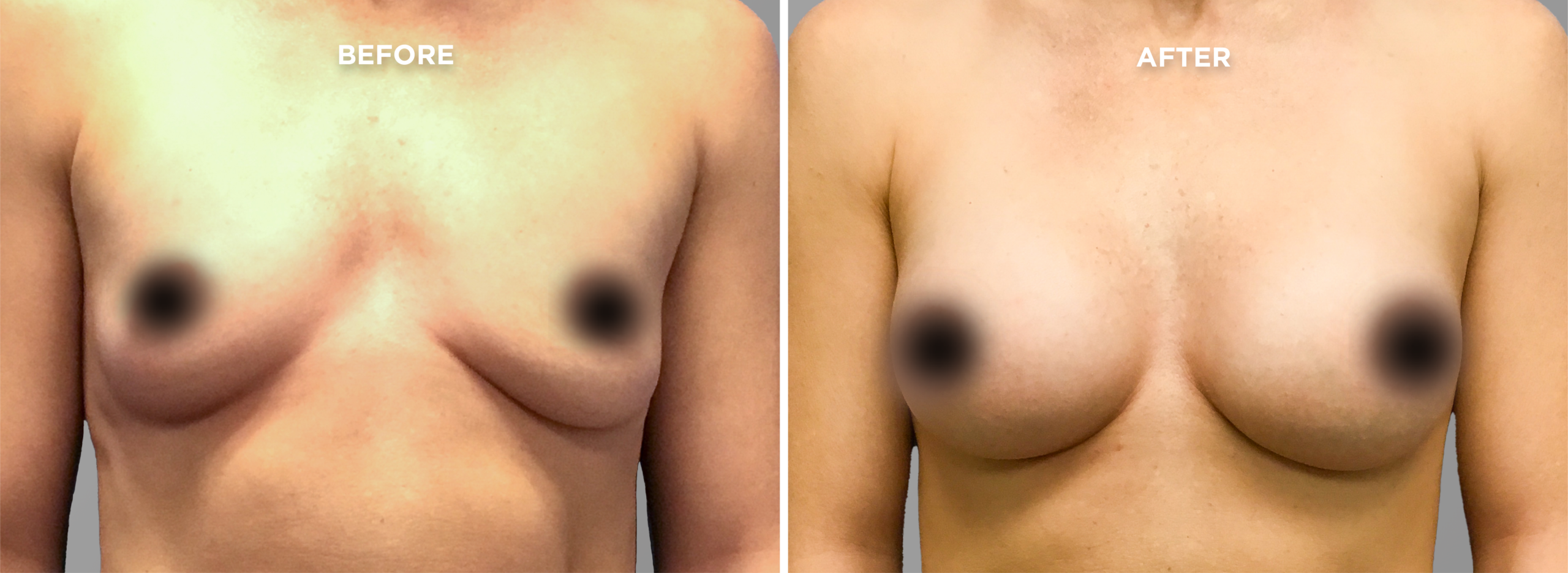 Breast Augment & Lift Before and After front 1