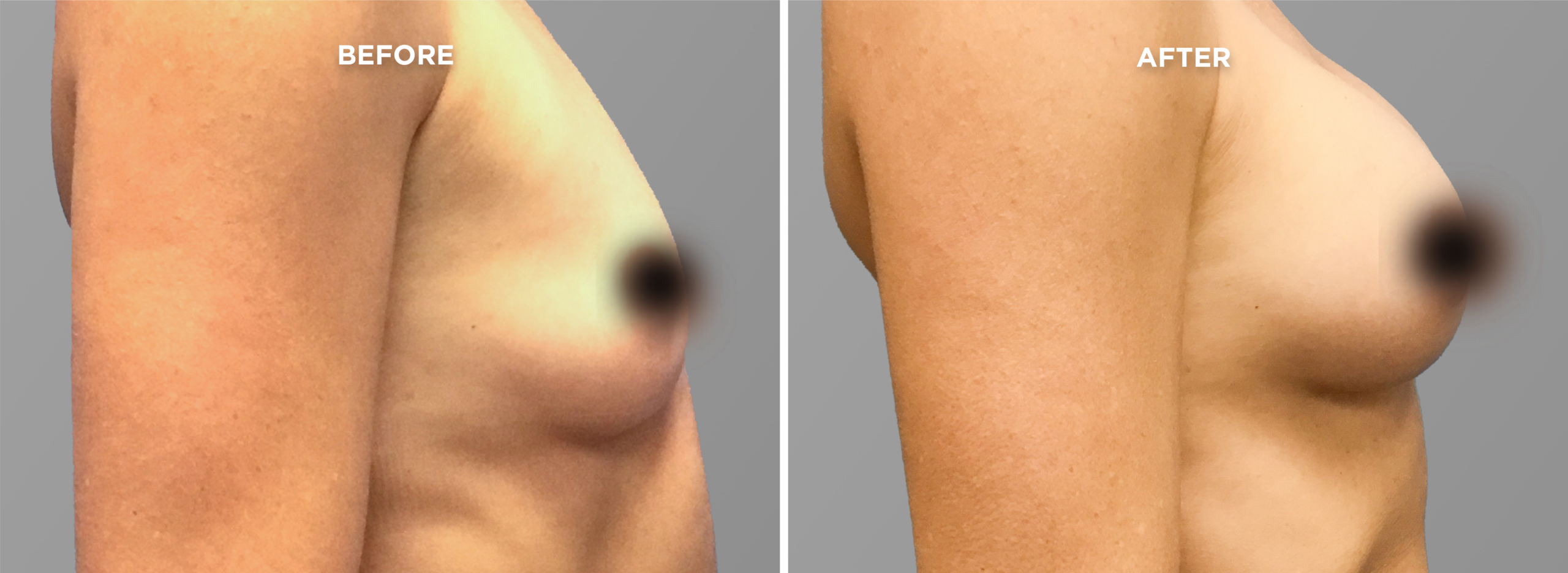 Breast Augment & Lift Before and After side 1