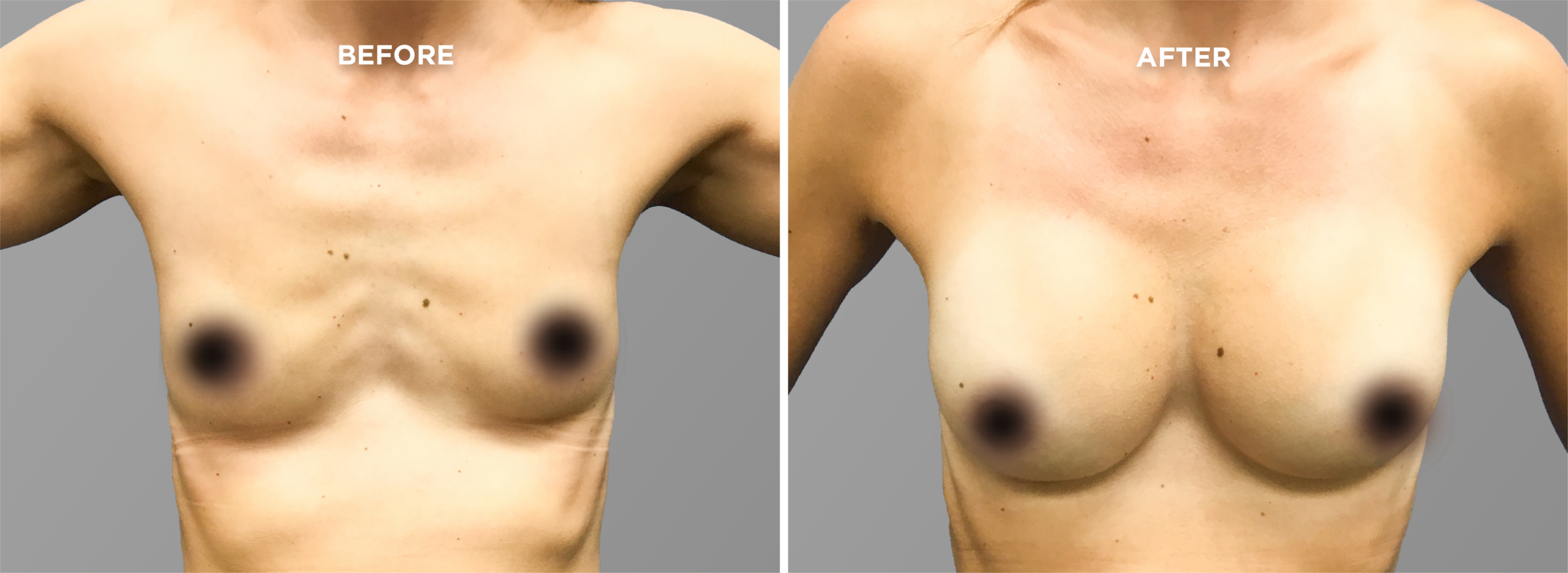 Breast Augment & Lift Before and After front 1