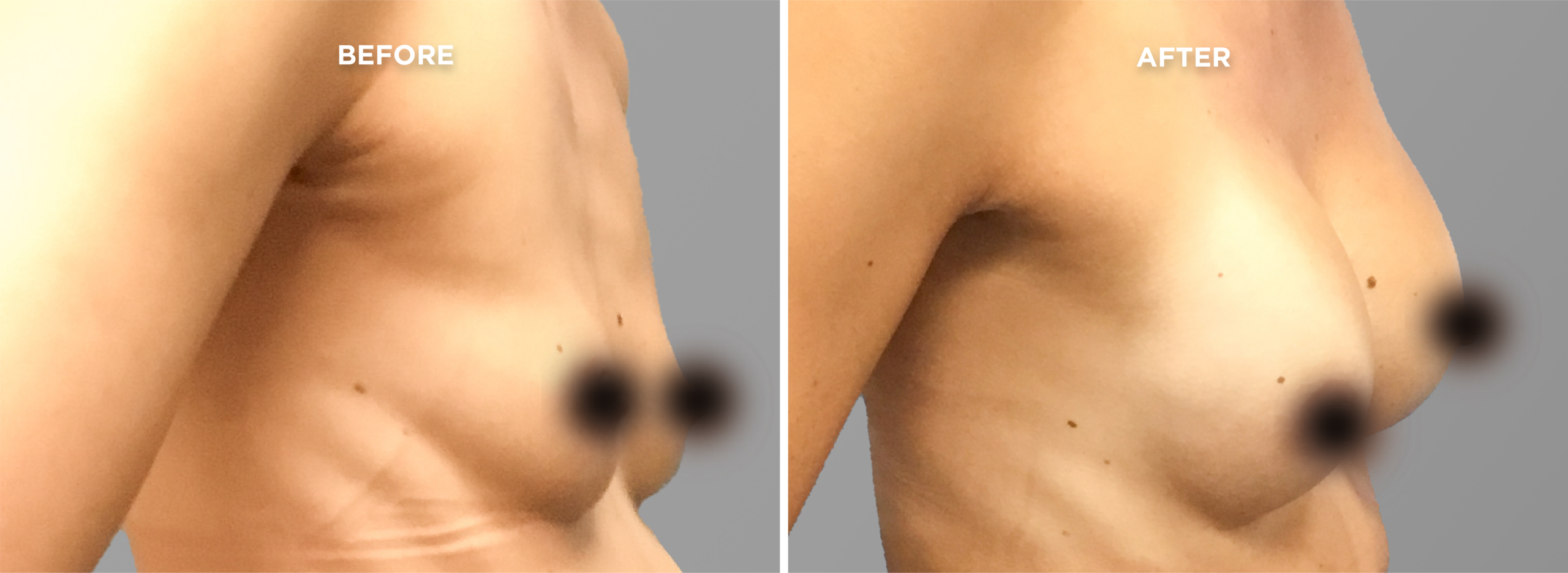 Breast Augment & Lift Before and After side 1
