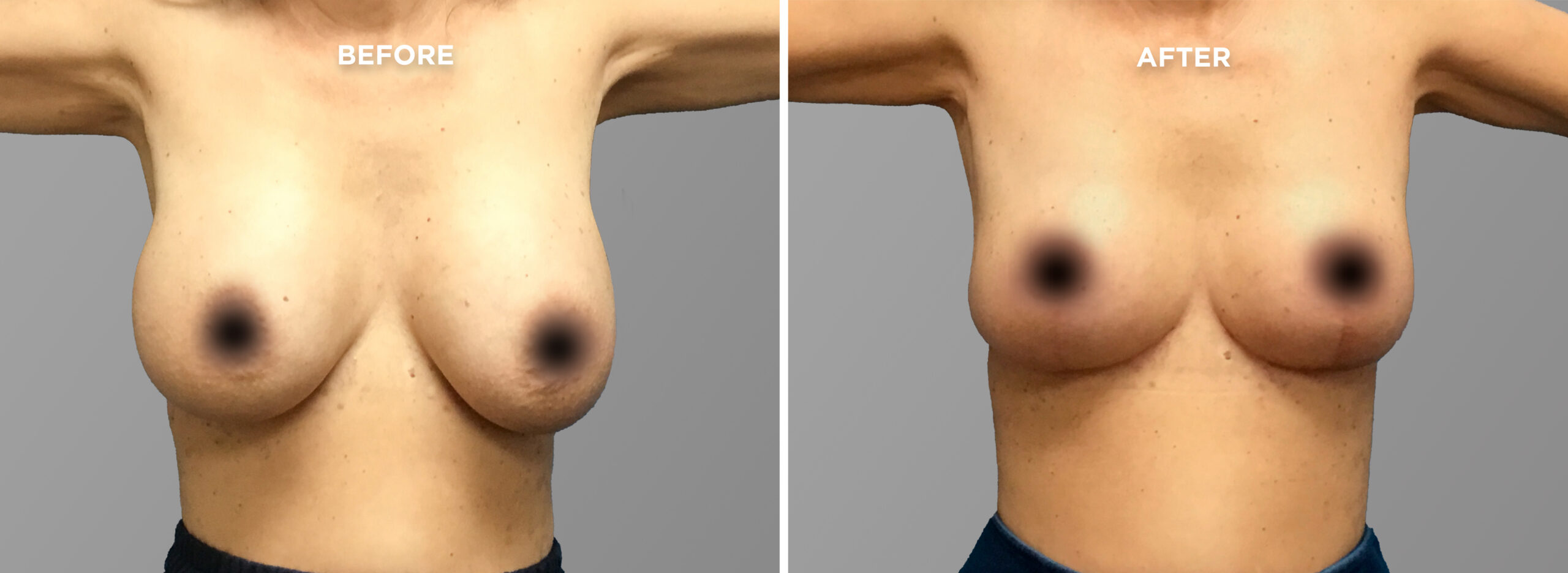 Breast Augment & Lift Before and After front 1