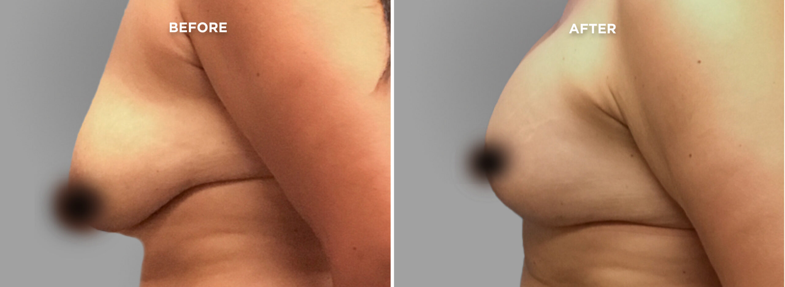 Breast Augment & Lift Before and After side 1