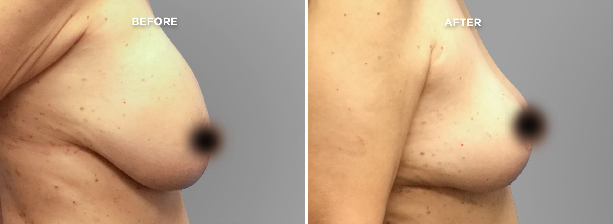 Breast Augment & Lift Before and After side 1