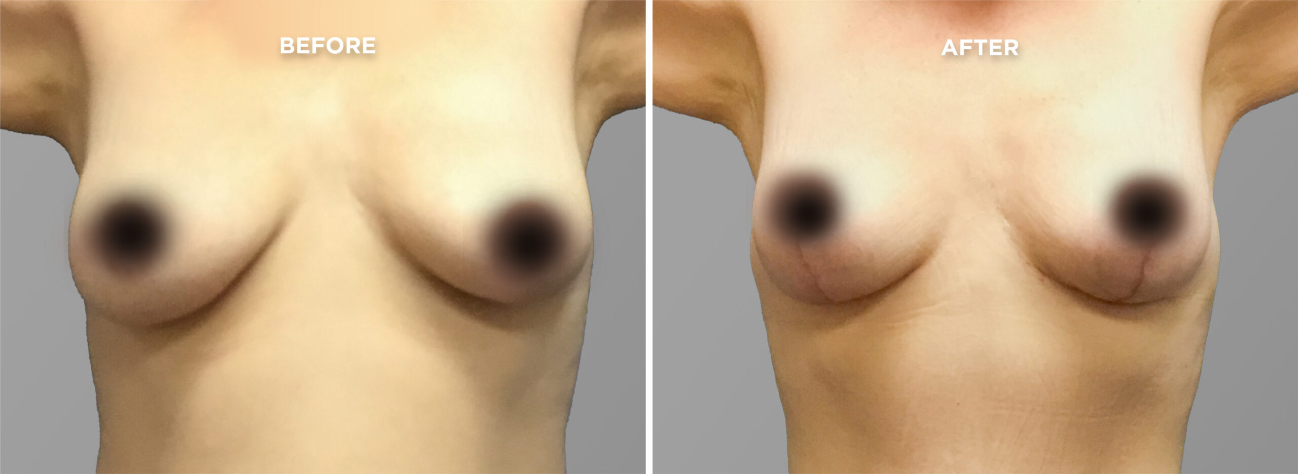 Breast Augment & Lift Before and After side 1