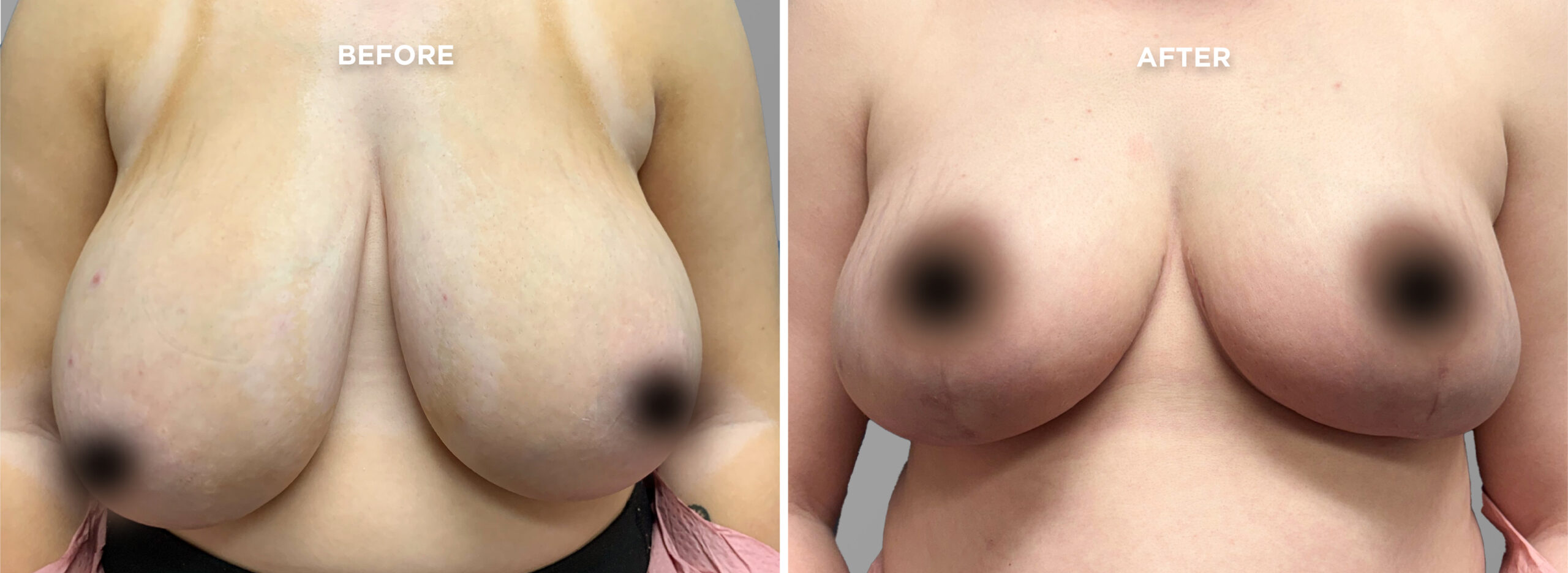 Breast Augment & Lift Before and After front 1