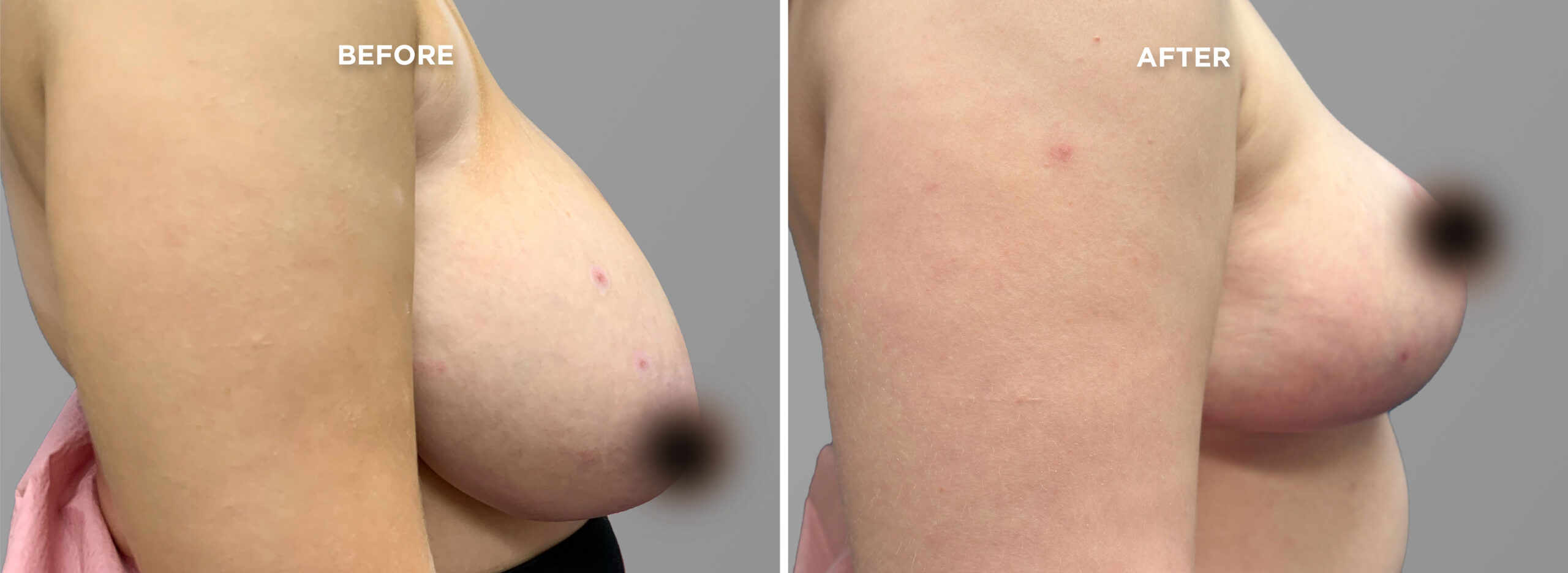 Breast Augment & Lift Before and After side 1