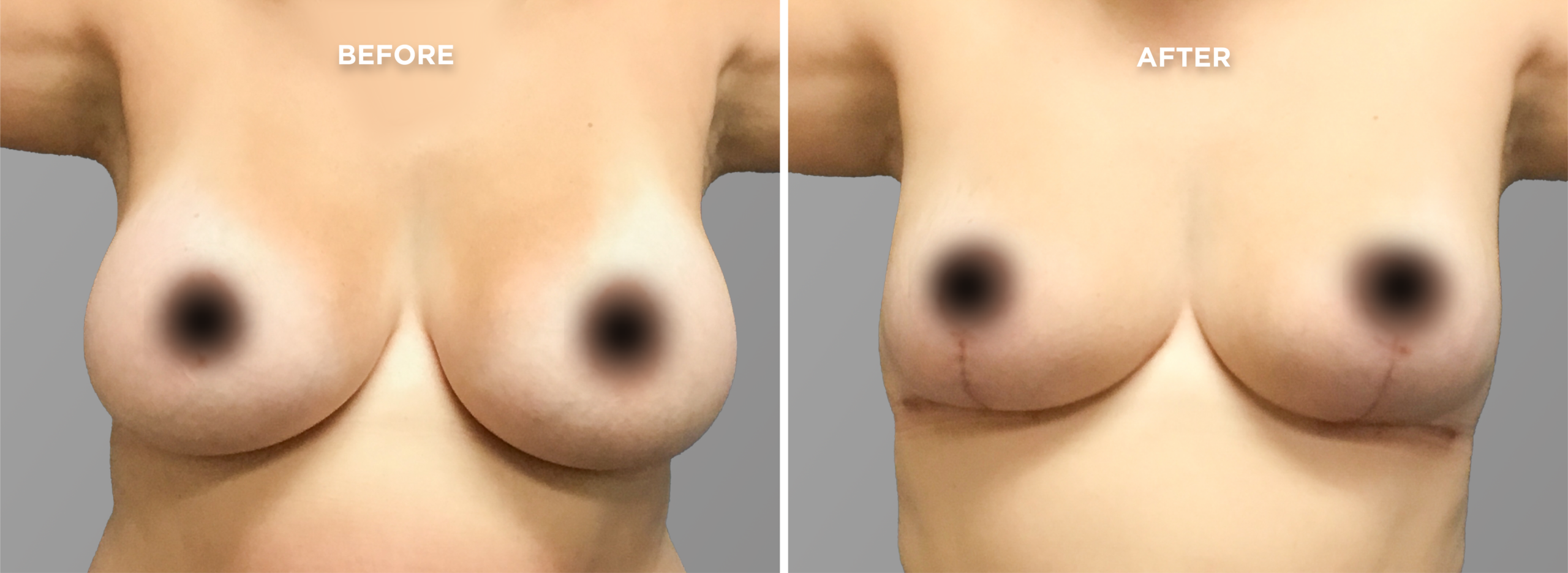 Breast Augment & Lift Before and After side 1
