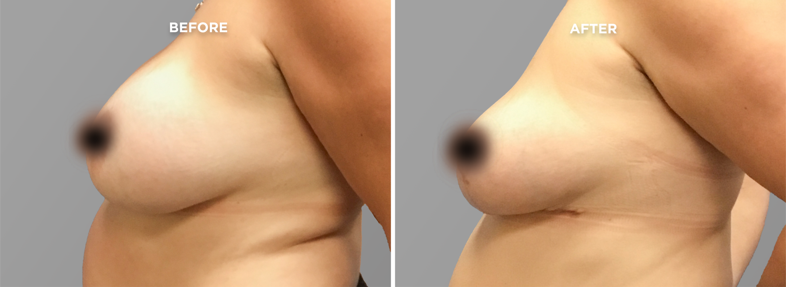 Breast Augment & Lift Before and After front 1