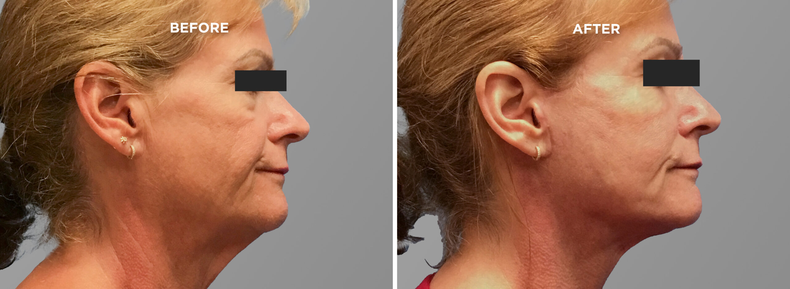 Breast Augment & Lift Before and After front 1