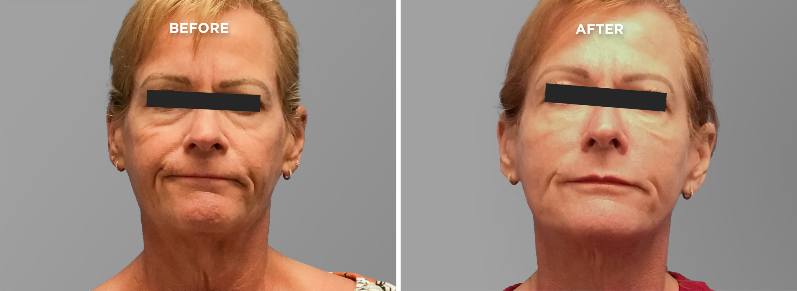 Breast Augment & Lift Before and After side 1