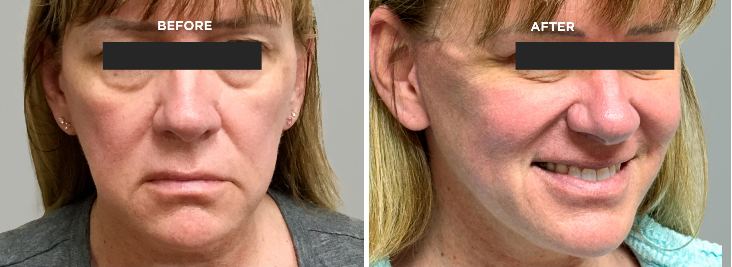 Breast Augment & Lift Before and After front 1