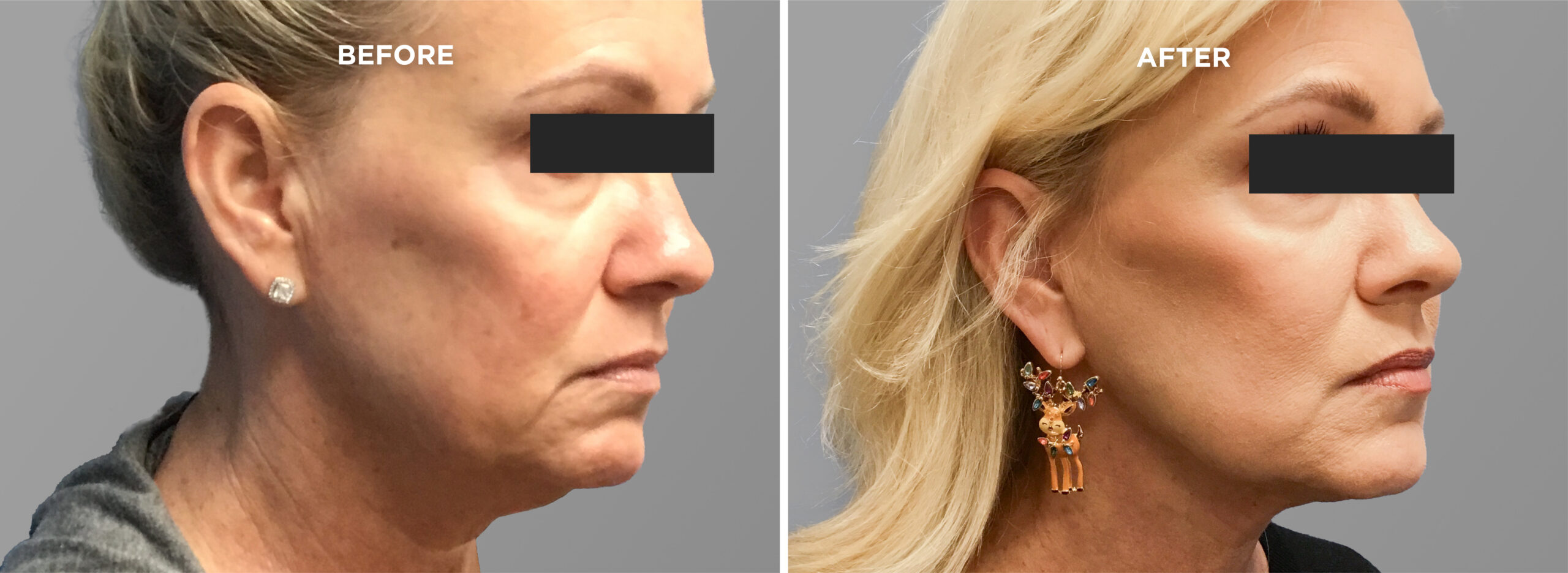 Breast Augment & Lift Before and After side 1