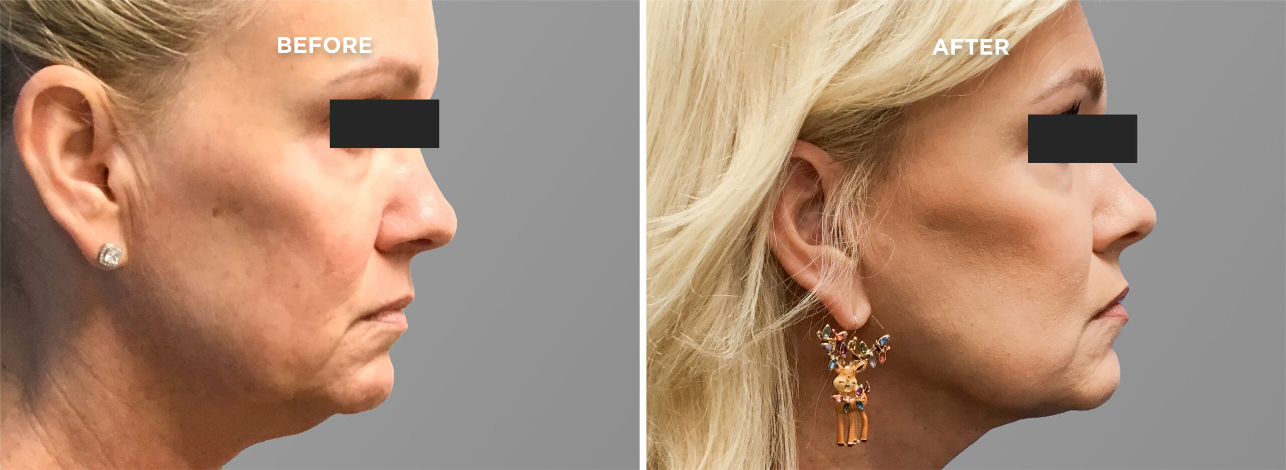 Breast Augment & Lift Before and After side 1