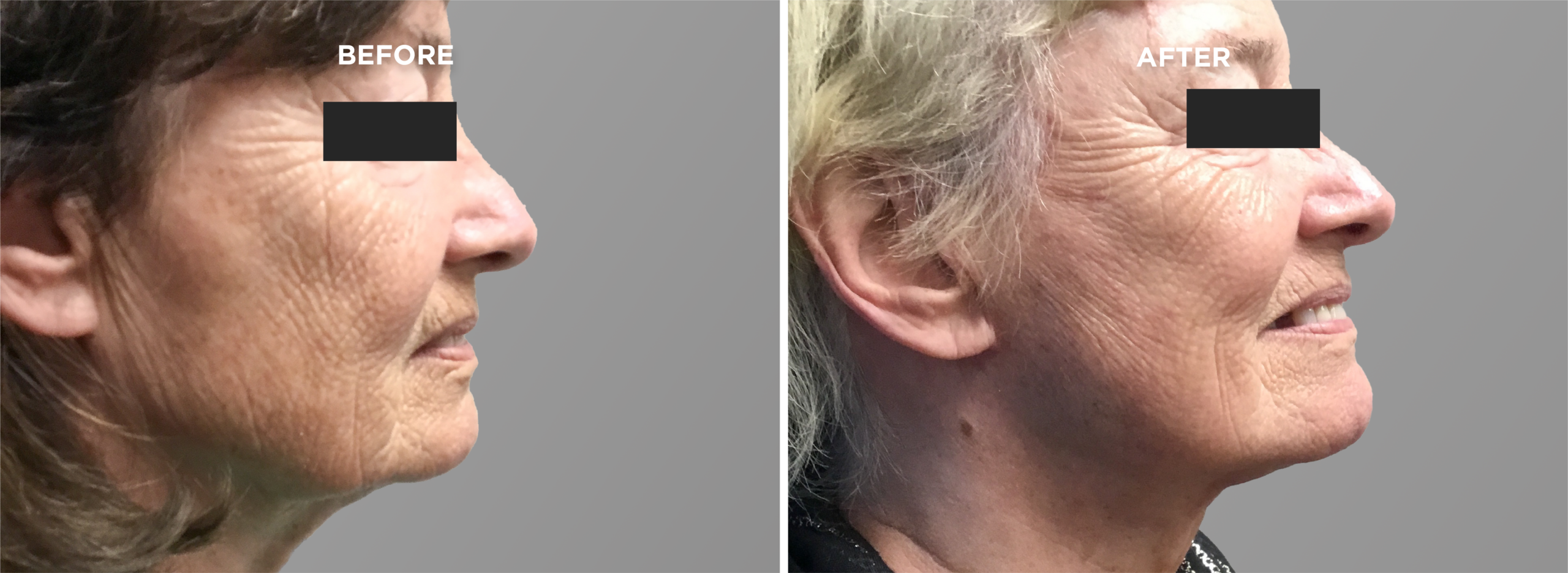 Breast Augment & Lift Before and After front 1