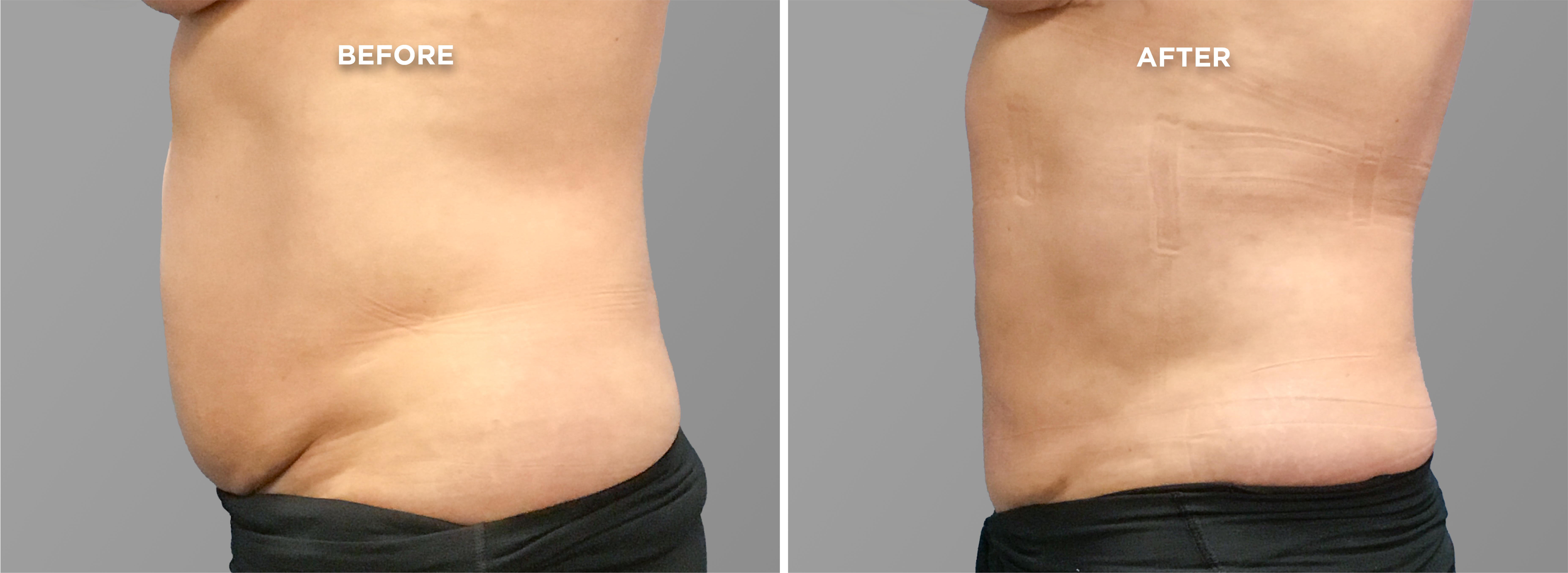 Breast Augment & Lift Before and After side 1