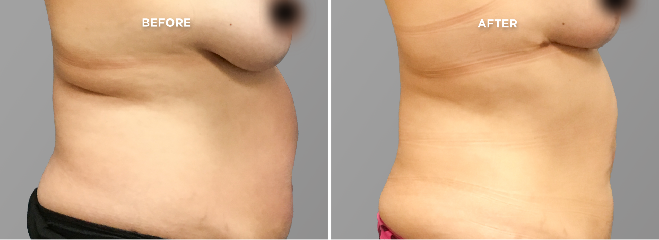 Breast Augment & Lift Before and After side 1