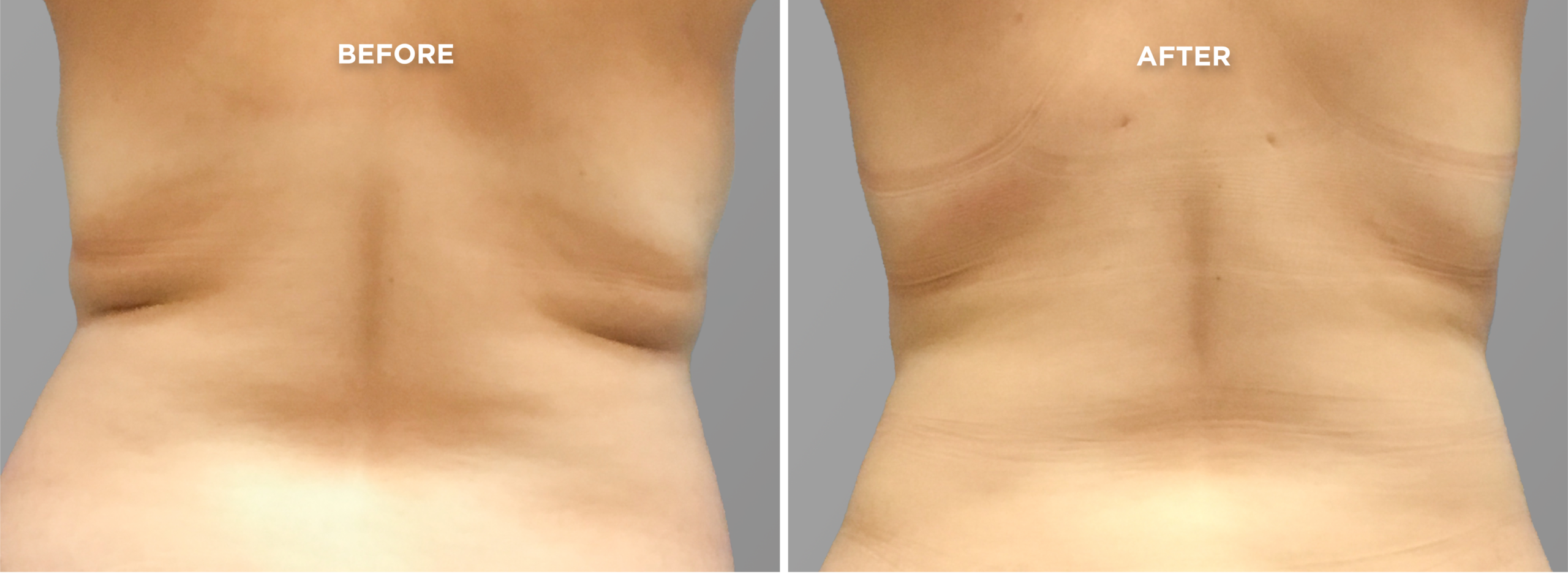 Breast Augment & Lift Before and After front 1