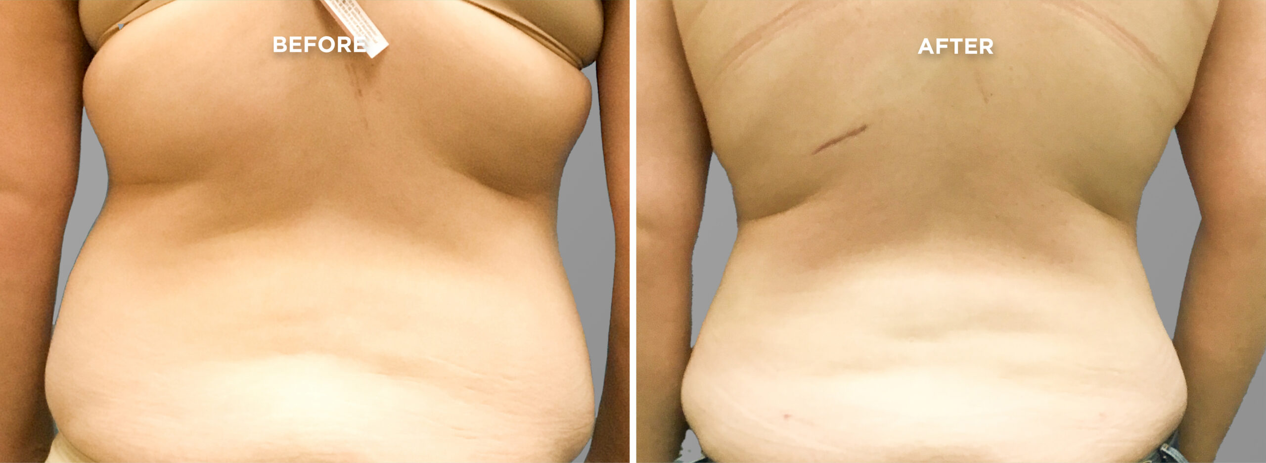 Breast Augment & Lift Before and After side 1