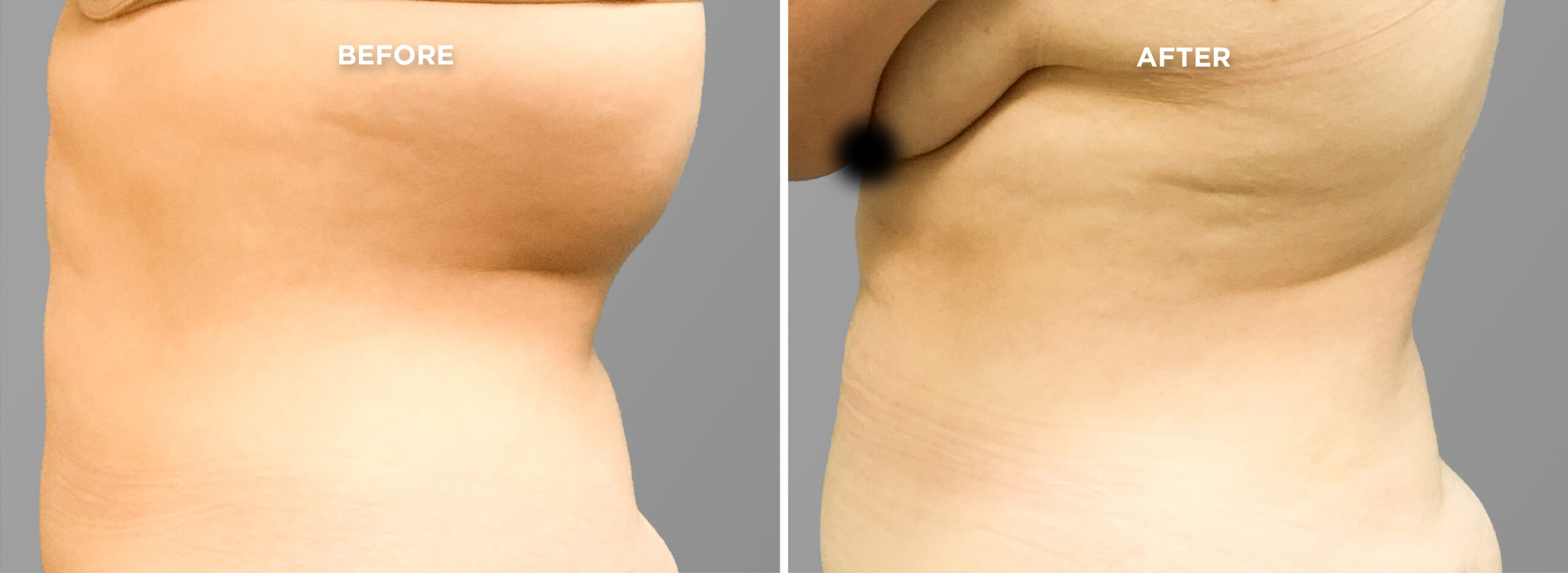 Breast Augment & Lift Before and After front 1