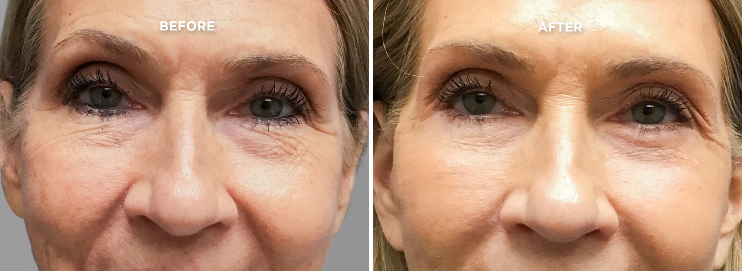 UPPER BLEPH BEFORE AND AFTER 1