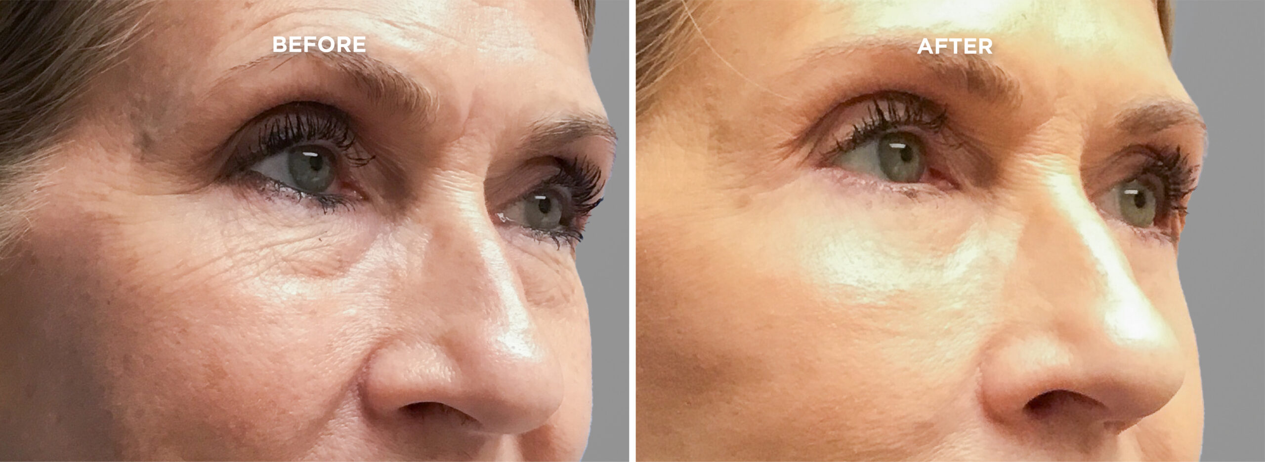 UPPER BLEPH BEFORE AND AFTER 1