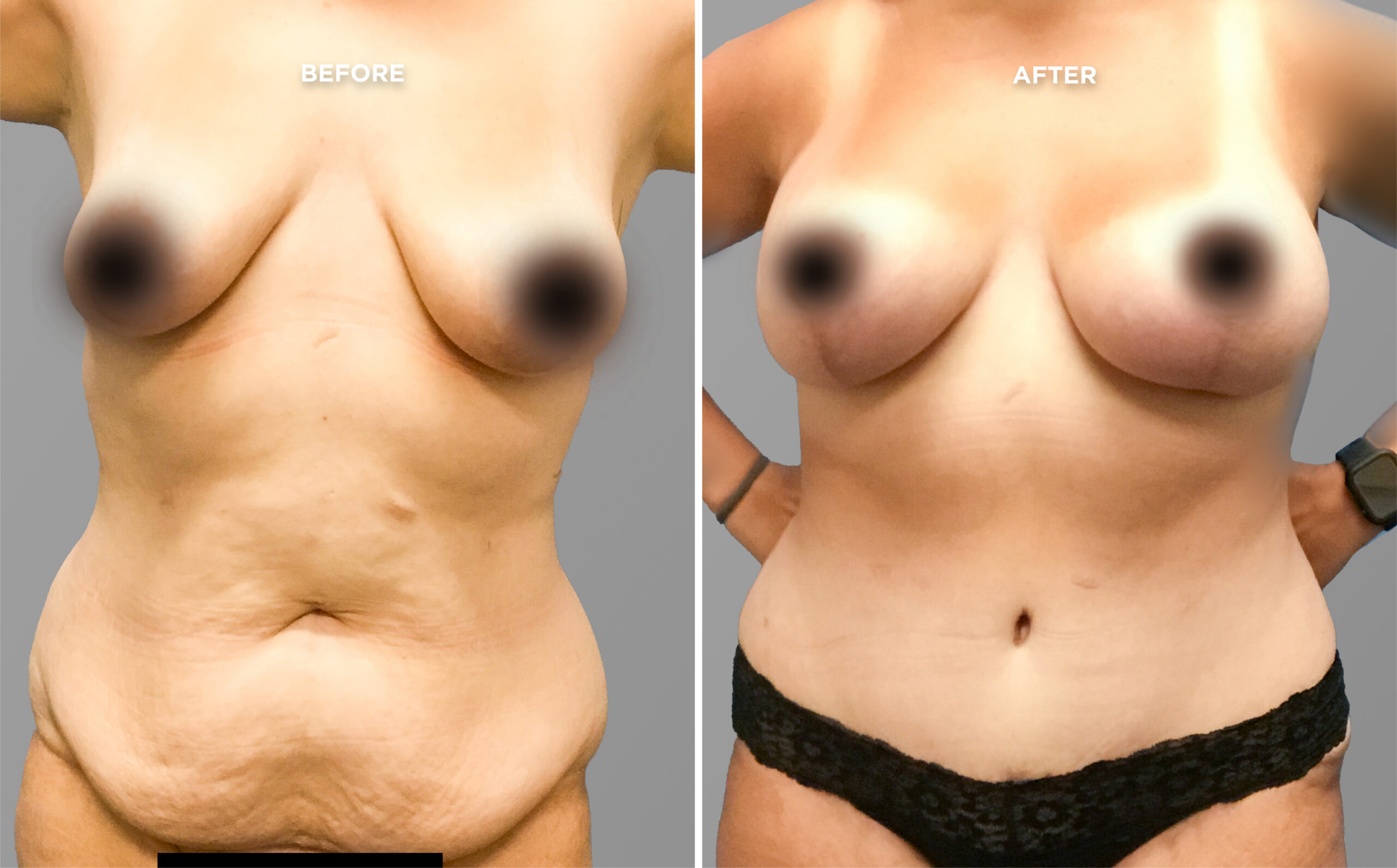 Breast Augment & Lift Before and After side 1