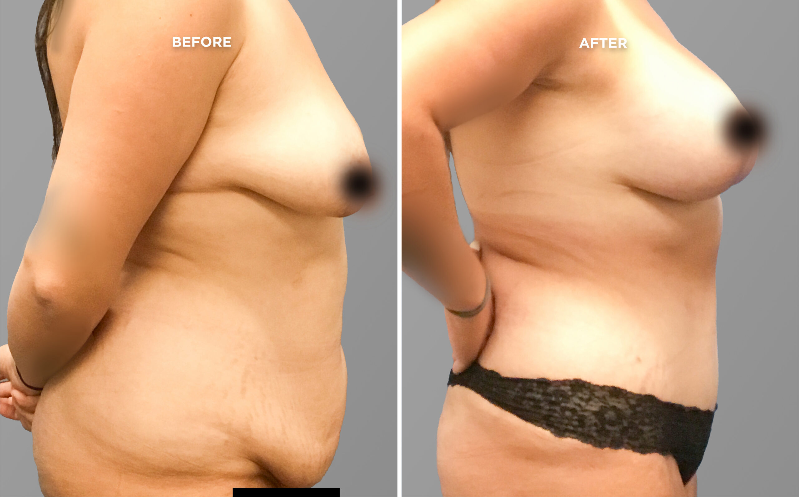 Breast Augment & Lift Before and After front 1