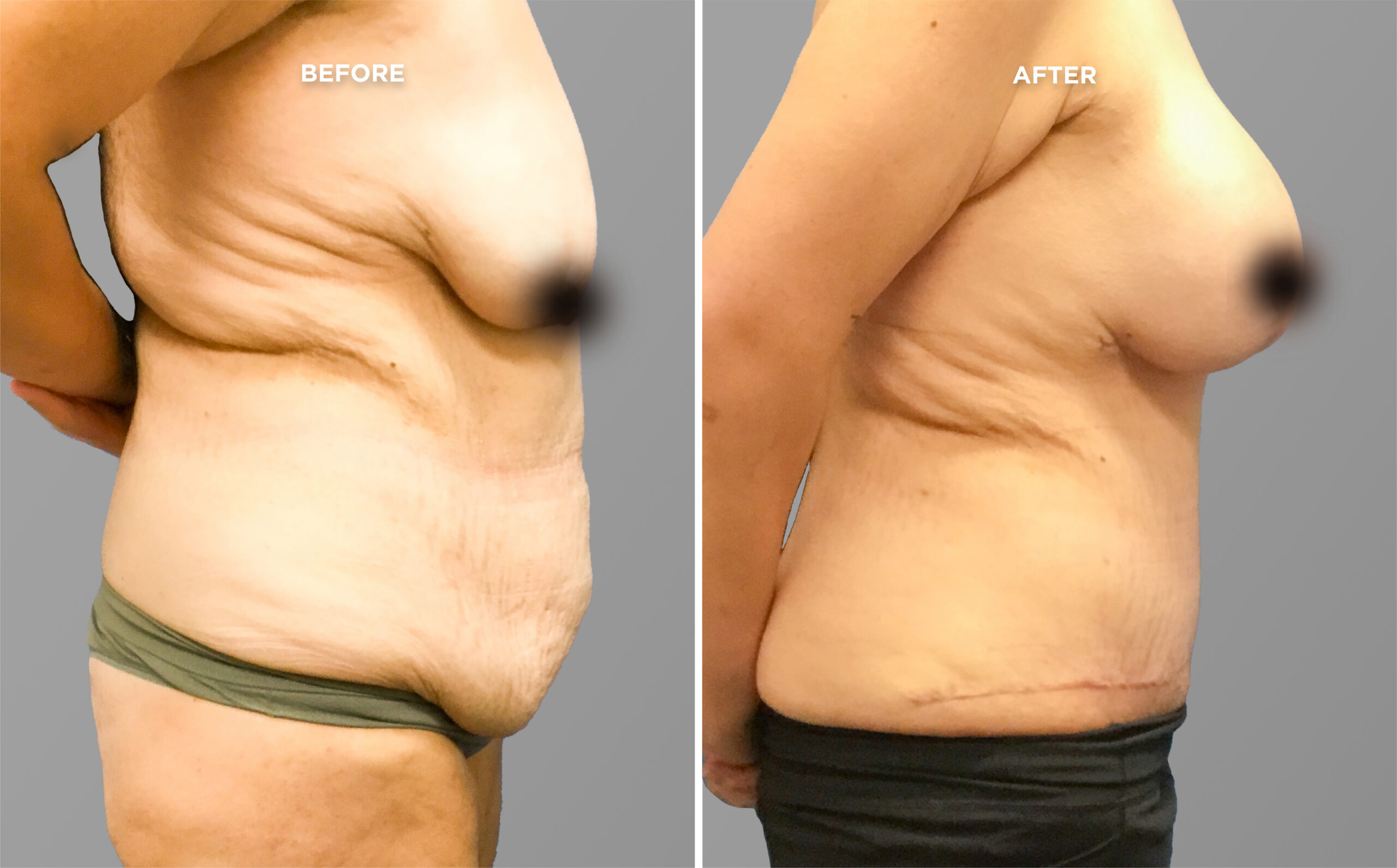 Breast Augment & Lift Before and After side 1