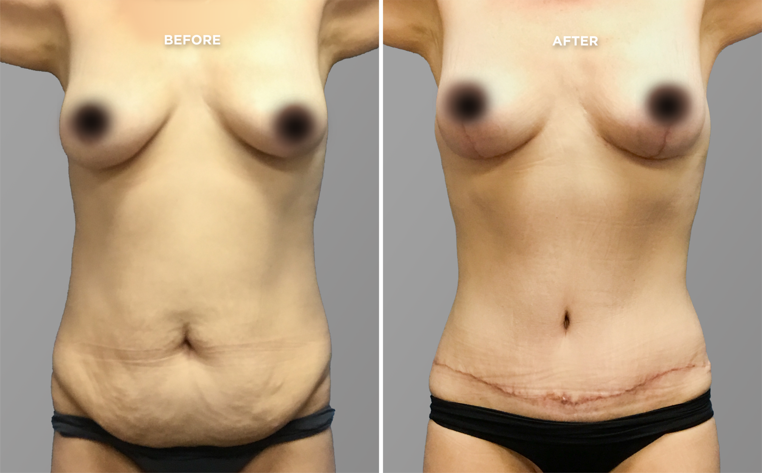 Breast Augment & Lift Before and After front 1