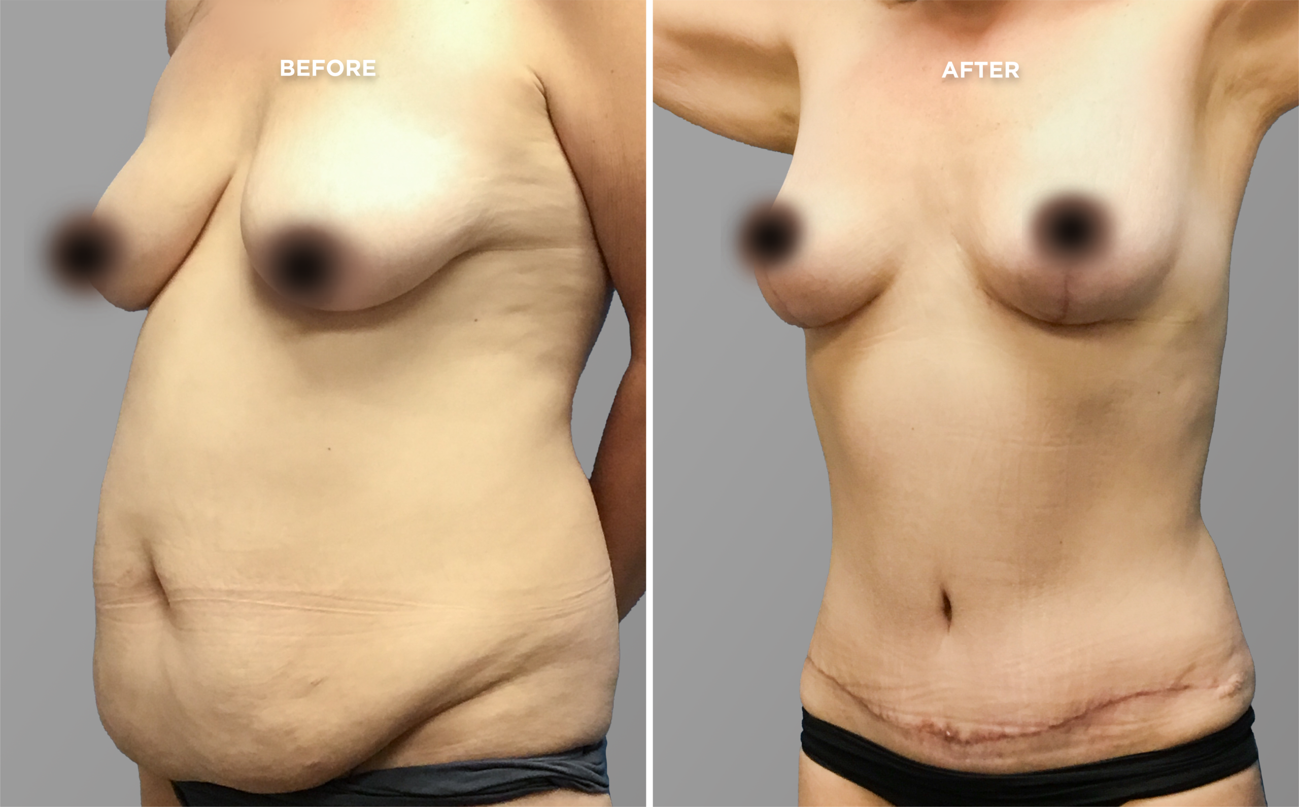 Breast Augment & Lift Before and After side 1