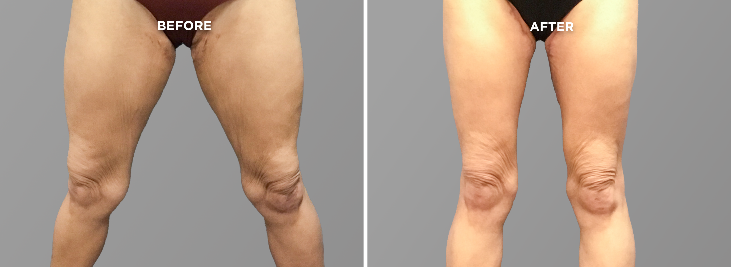 Breast Augment & Lift Before and After front 1