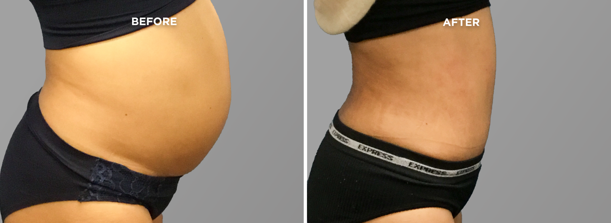 Breast Augment & Lift Before and After front 1