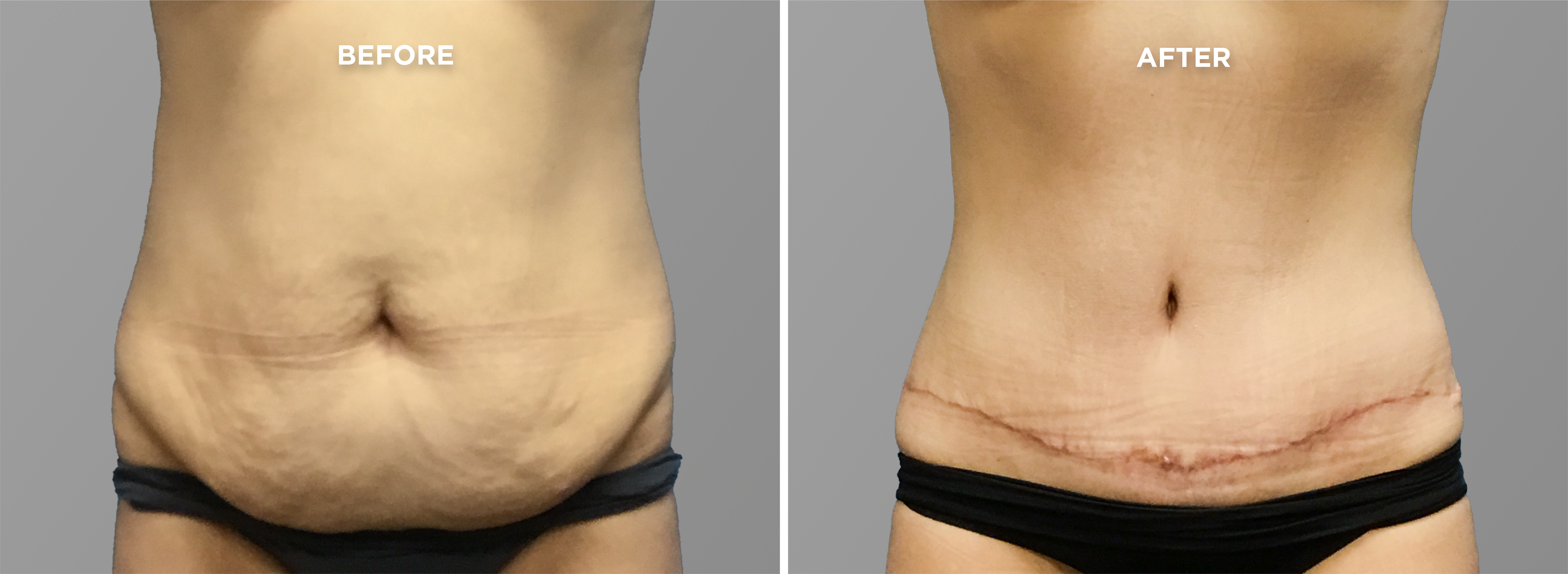Breast Augment & Lift Before and After side 1