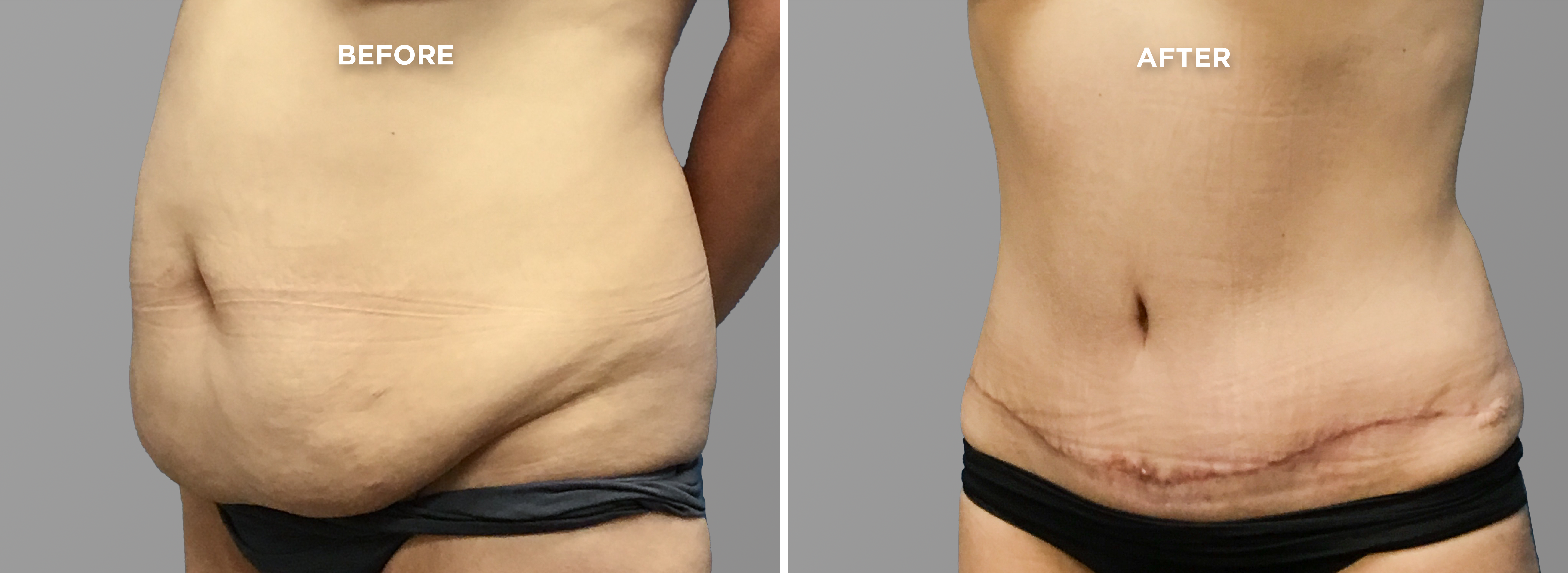 Breast Augment & Lift Before and After front 1