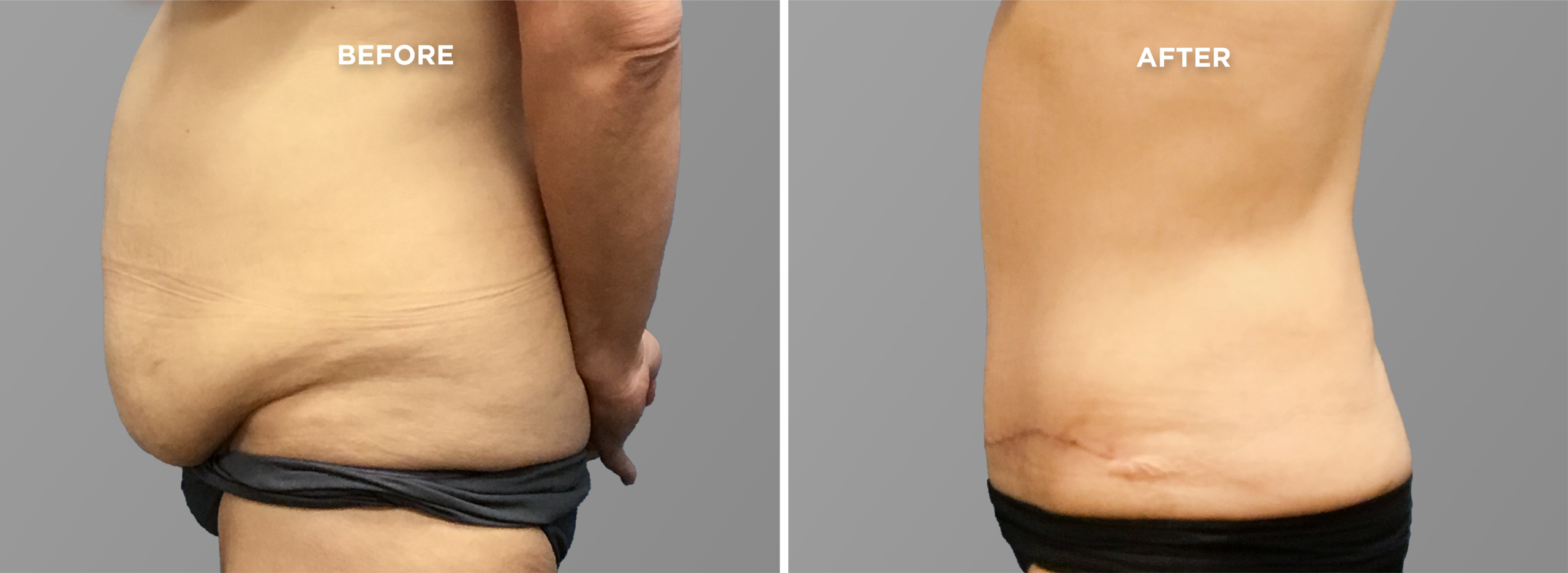 Breast Augment & Lift Before and After side 1