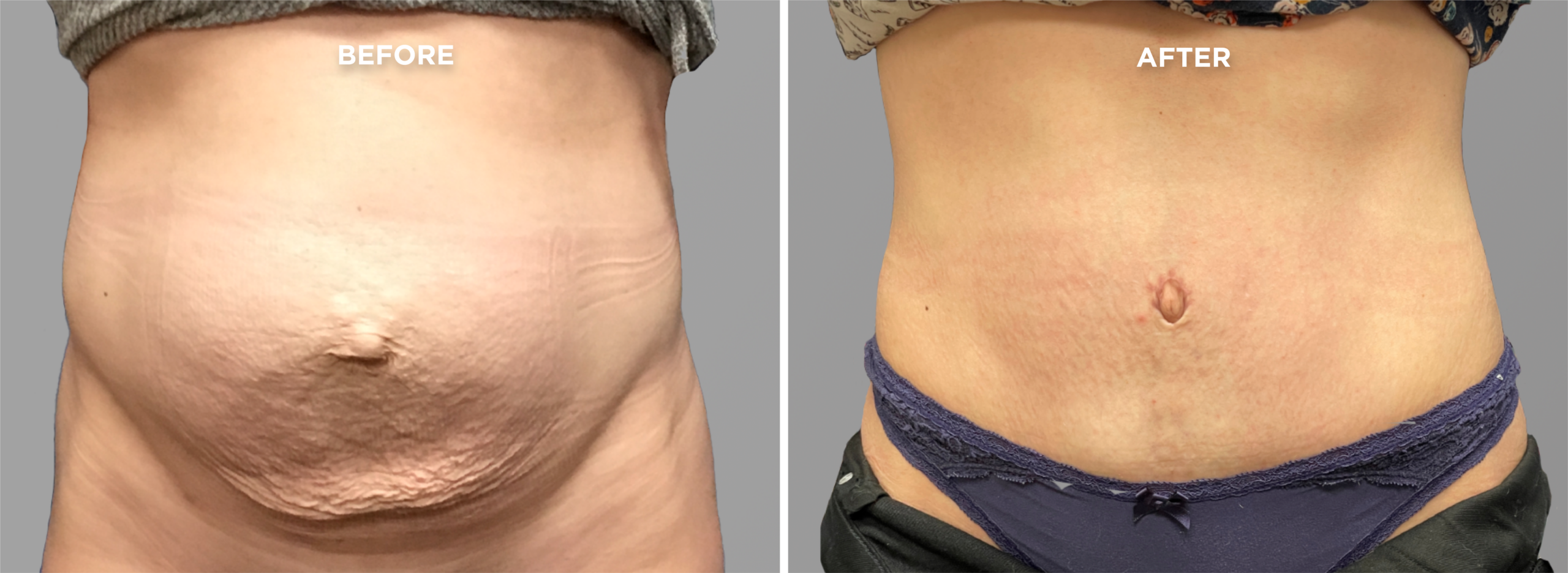 Breast Augment & Lift Before and After front 1