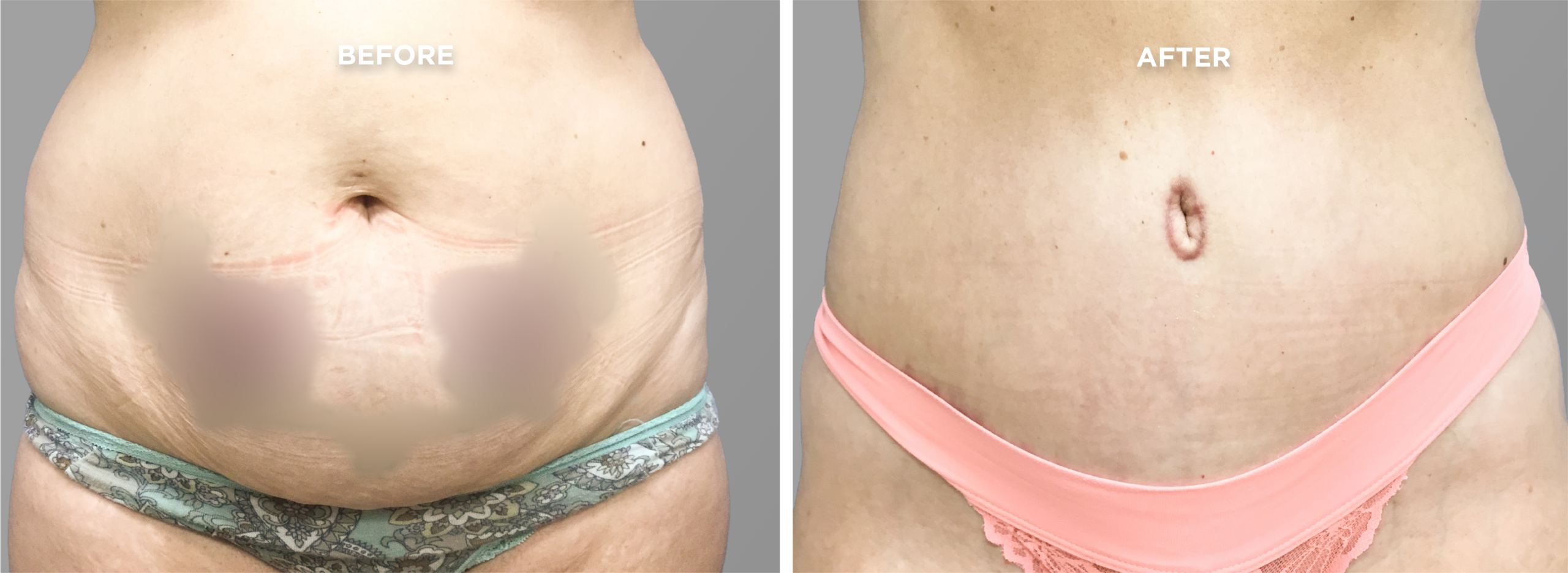Breast Augment & Lift Before and After side 1