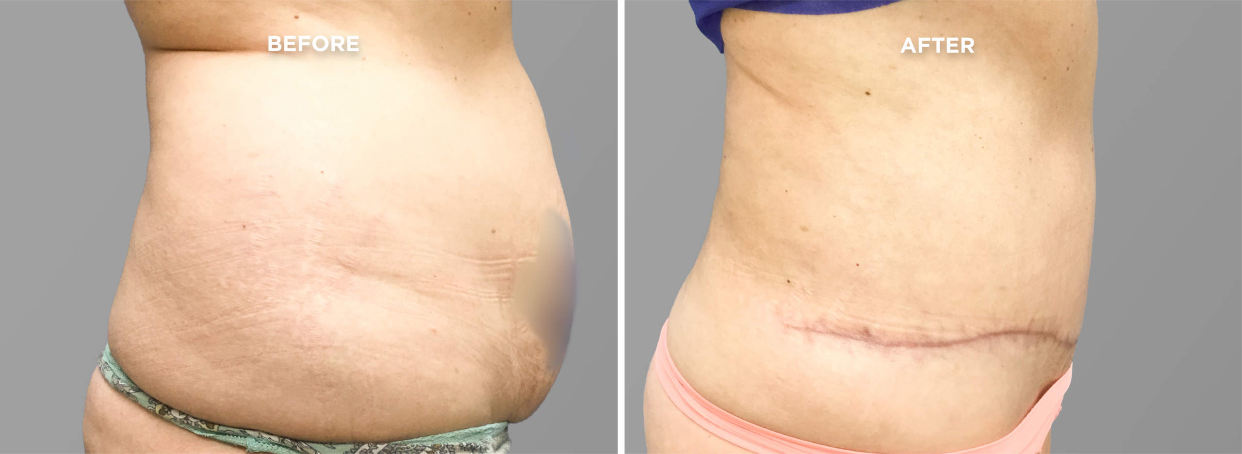 Breast Augment & Lift Before and After side 1