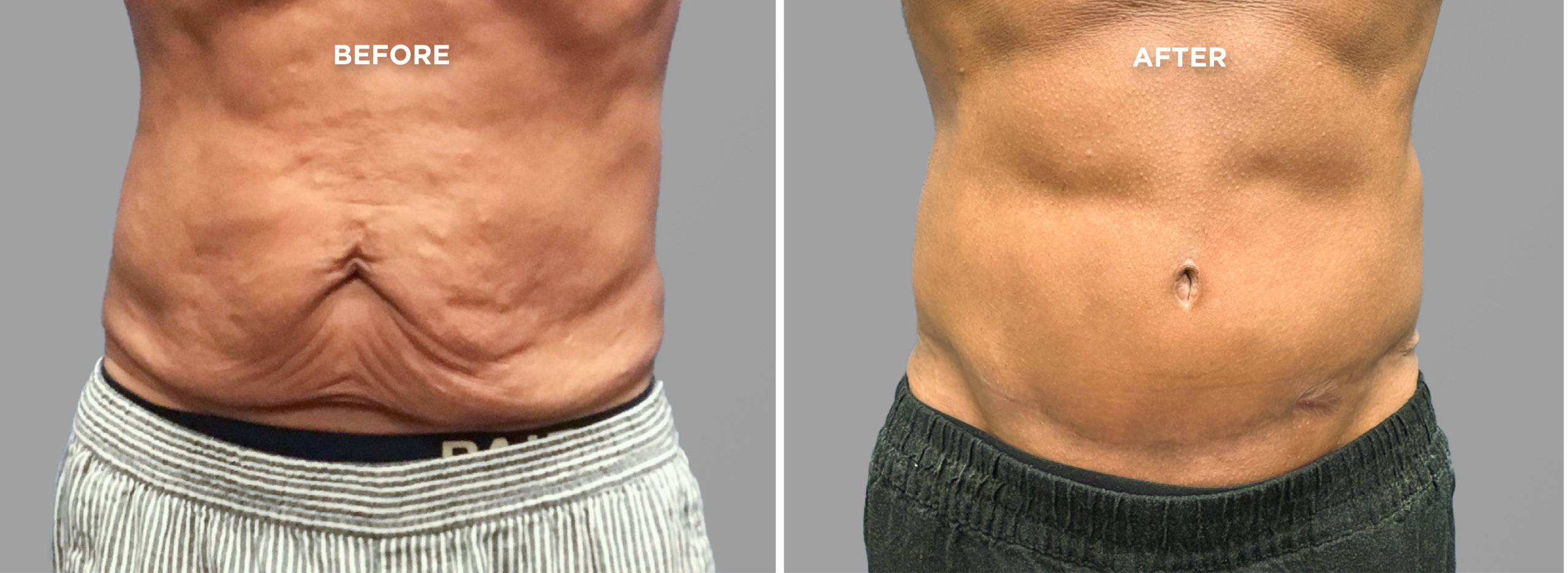 Breast Augment & Lift Before and After front 1