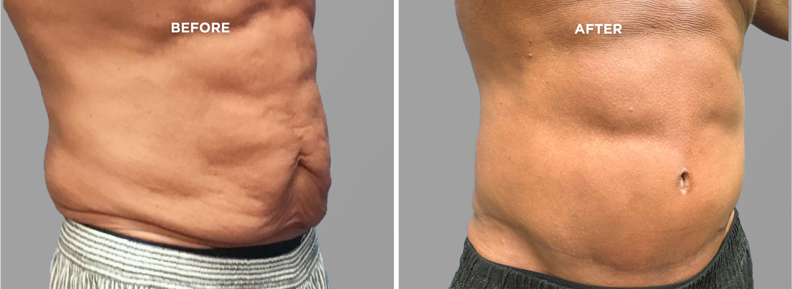 Breast Augment & Lift Before and After front 1
