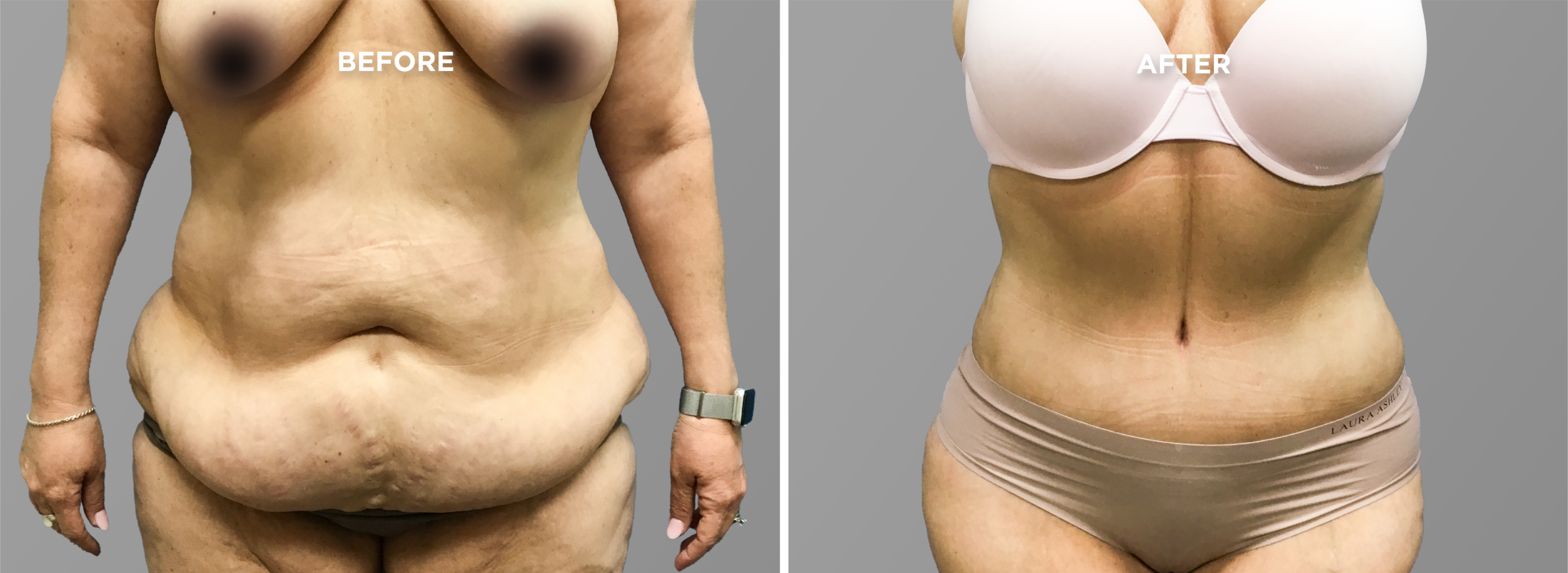 Breast Augment & Lift Before and After side 1