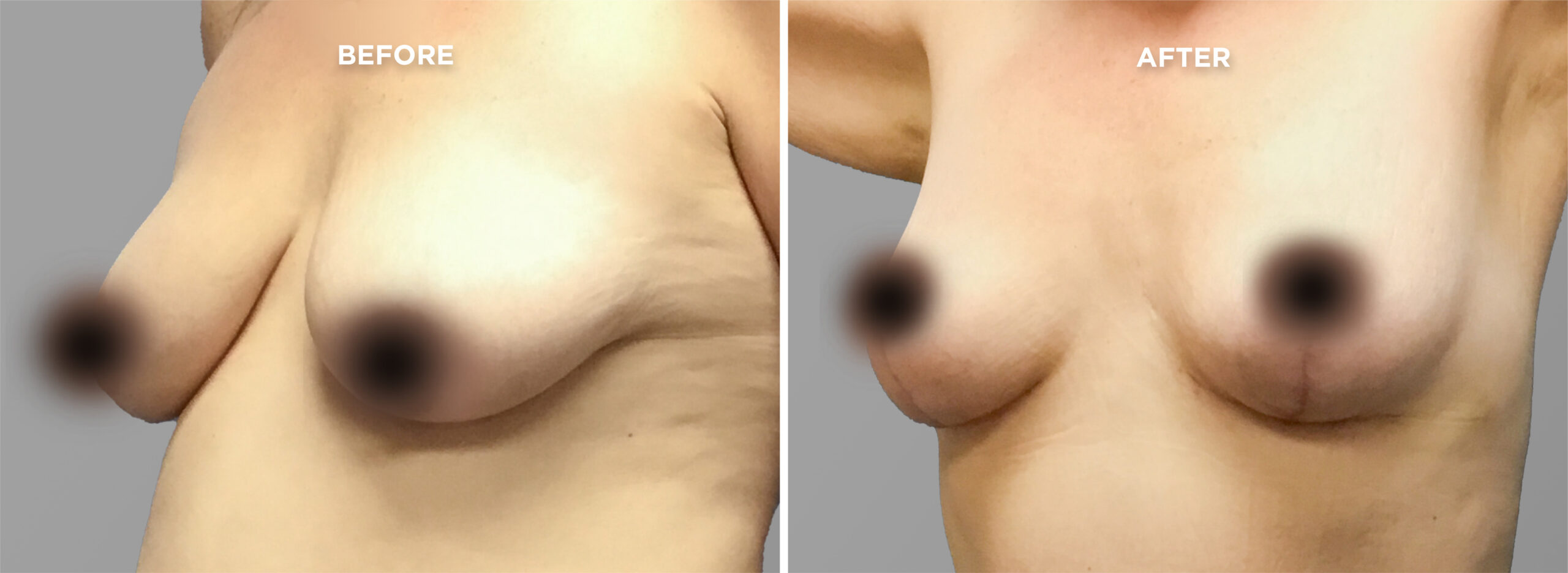 Breast Augment & Lift Before and After front 1