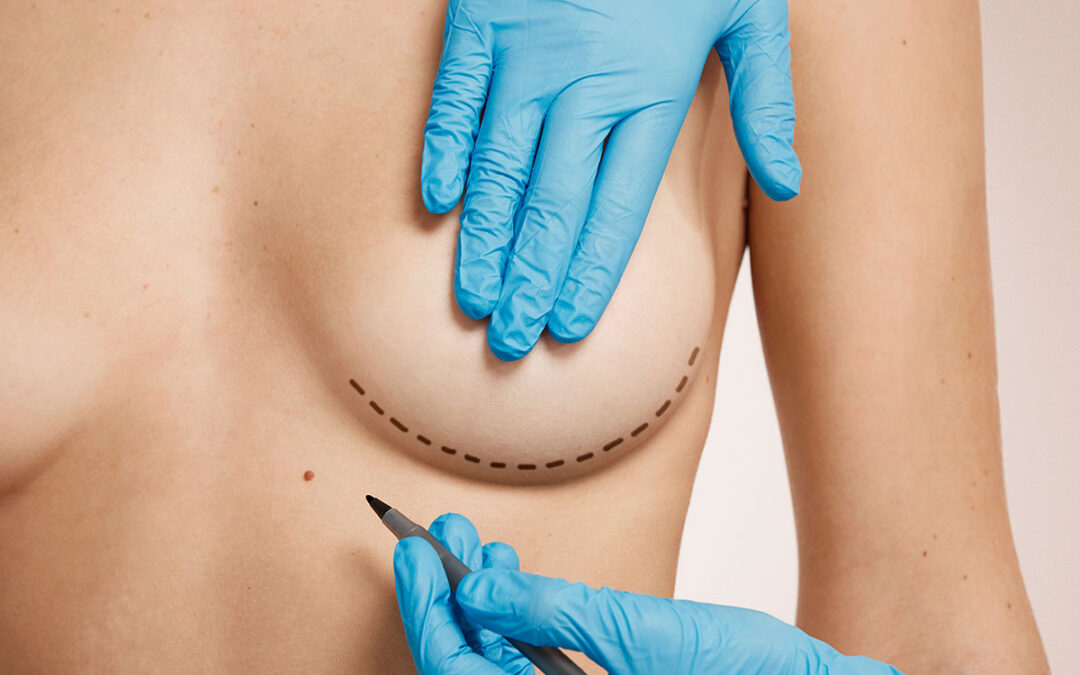 What to Know About Breast Augmentation Recovery Before Surgery