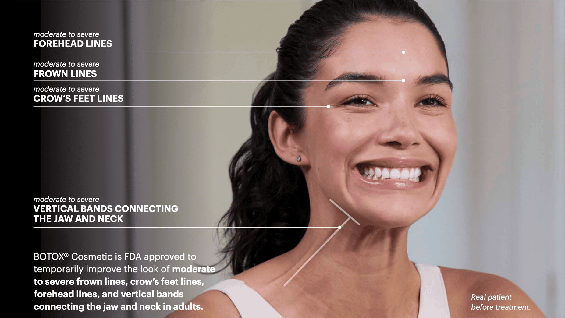 BOTOX Cosmetic FDA approved treatment areas