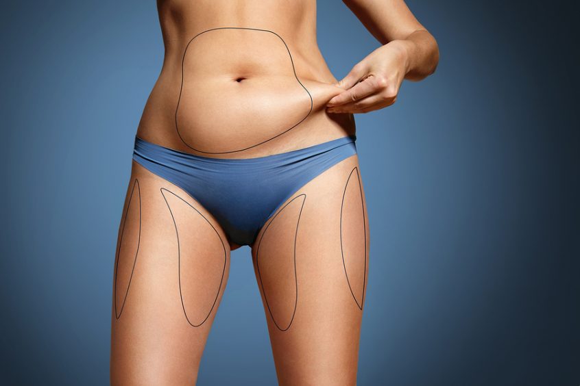 Liposuction | Forsyth Plastic Surgery